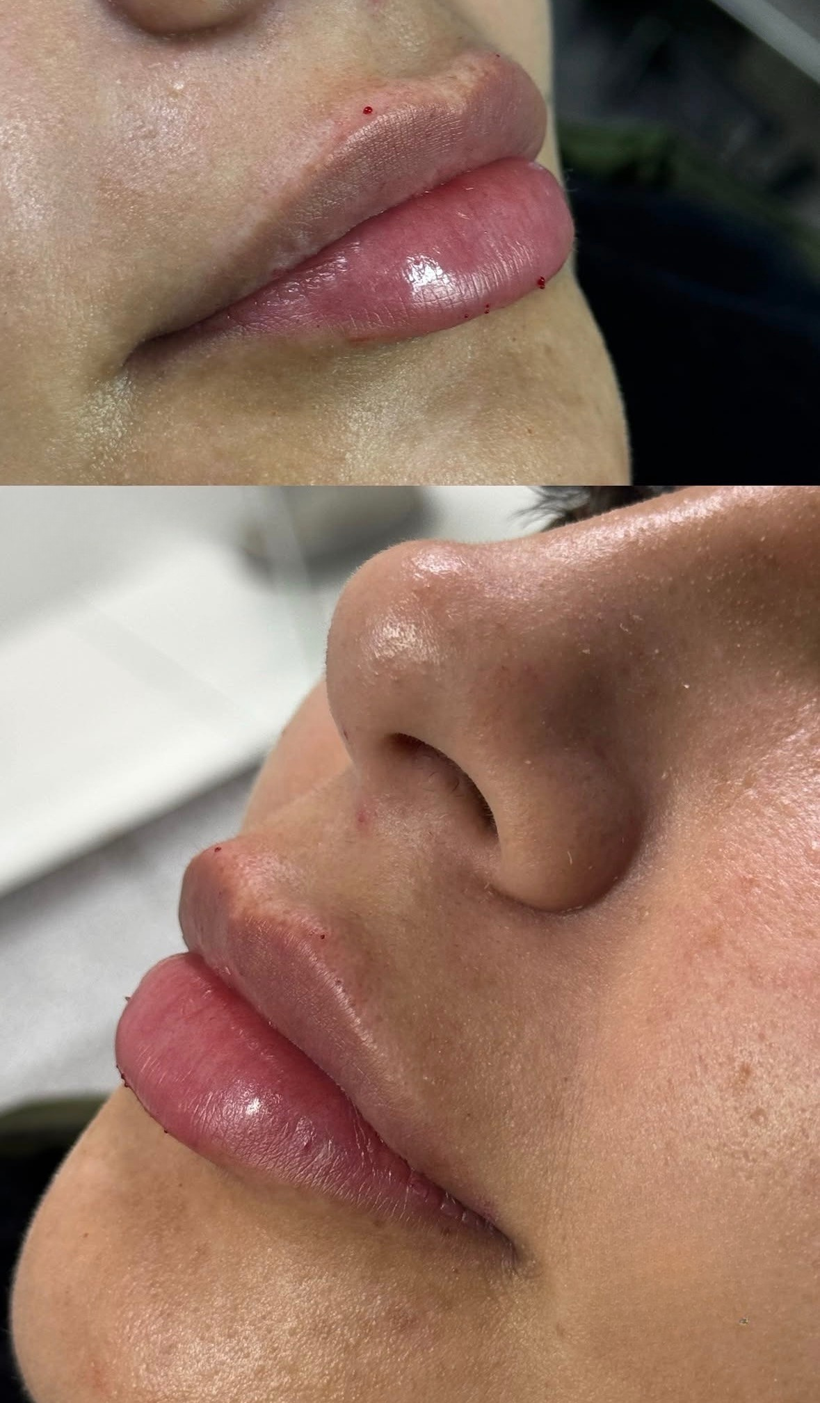 Resultado perfilado labial