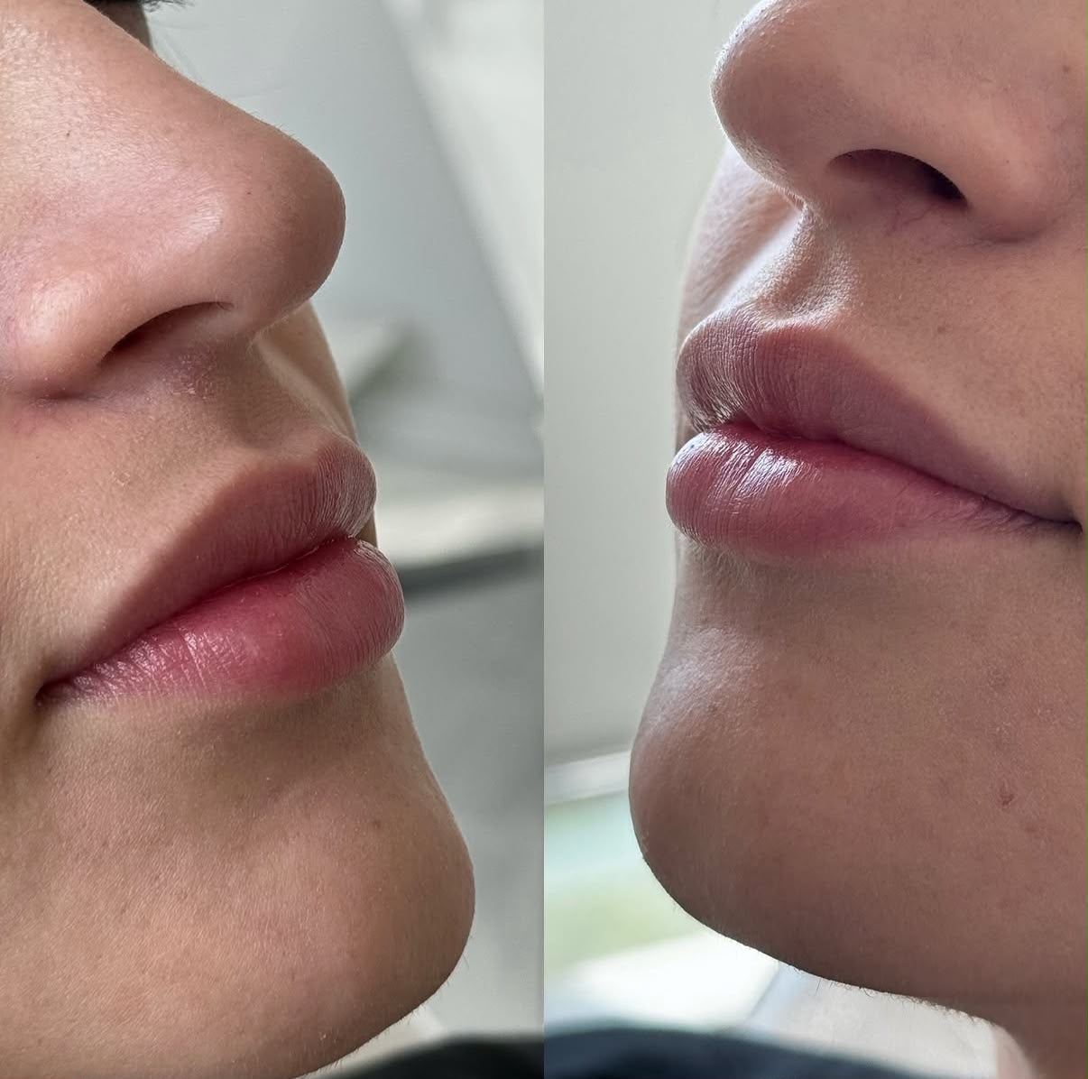 Resultado relleno de labios