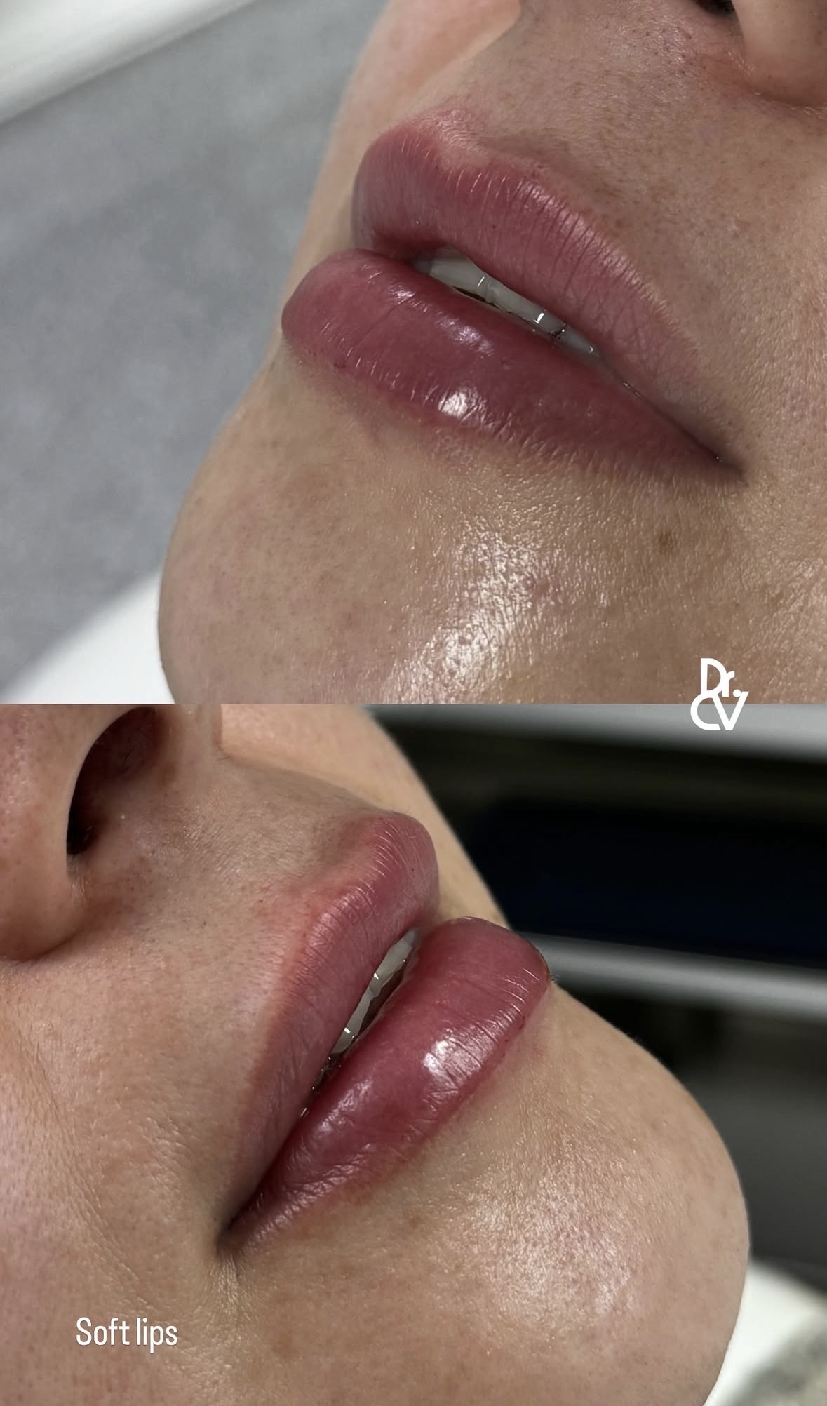 Resultado perfilado labial