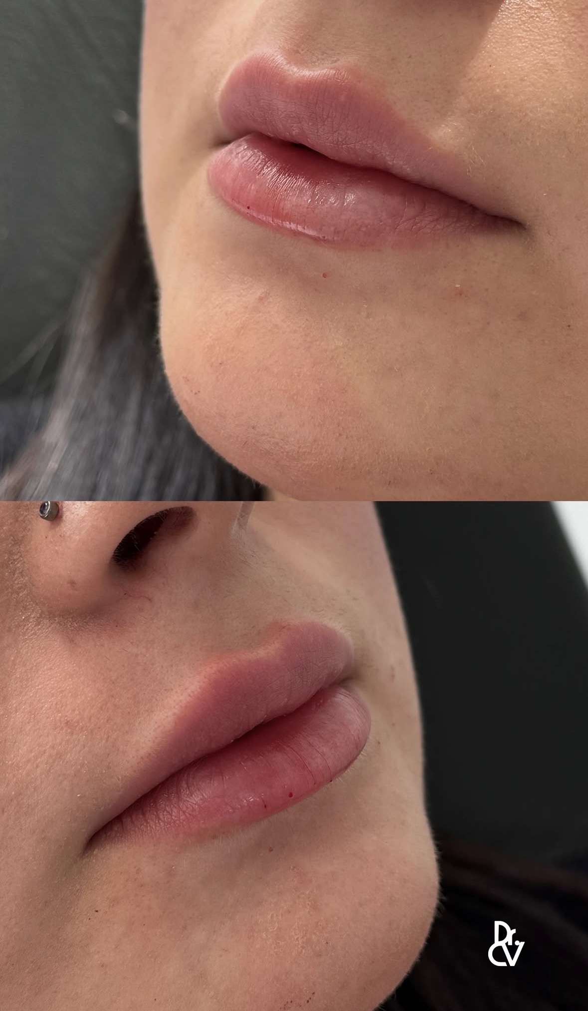 Resultado relleno de labios