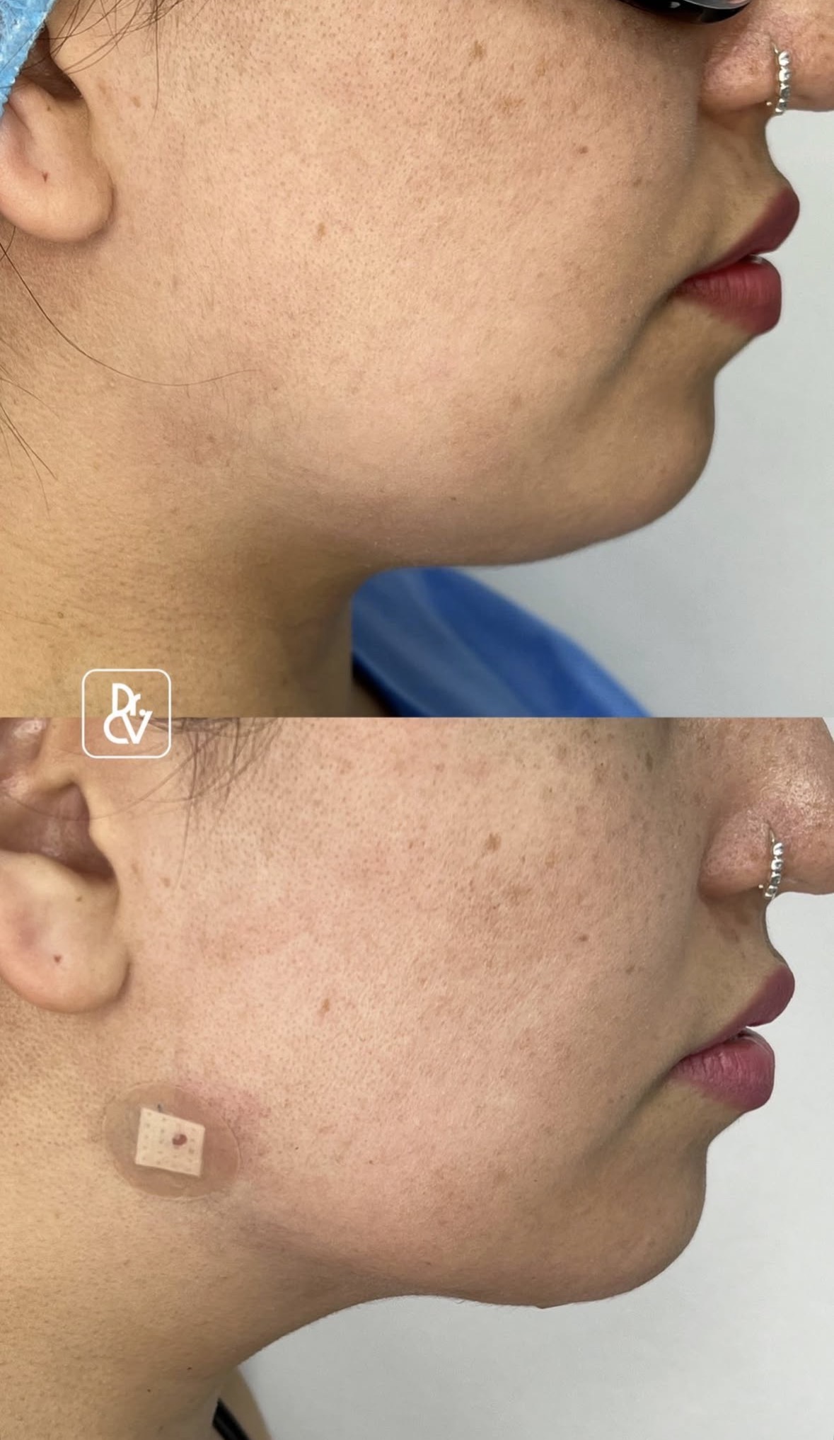 Resultado bichectomía y lipopapada
