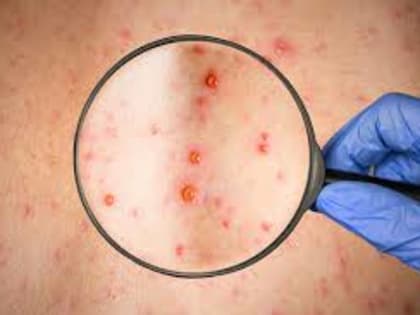 Осторожно: корь!