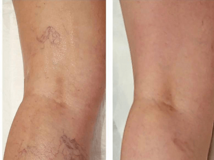 Как вылечить варикоз без операции