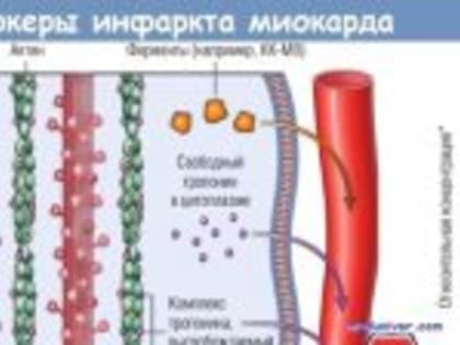Высокочувствительный тропонин-I для диагностики инфаркта миокарда
