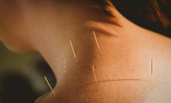 Acupuncture: Natural Healing Through Precision Points