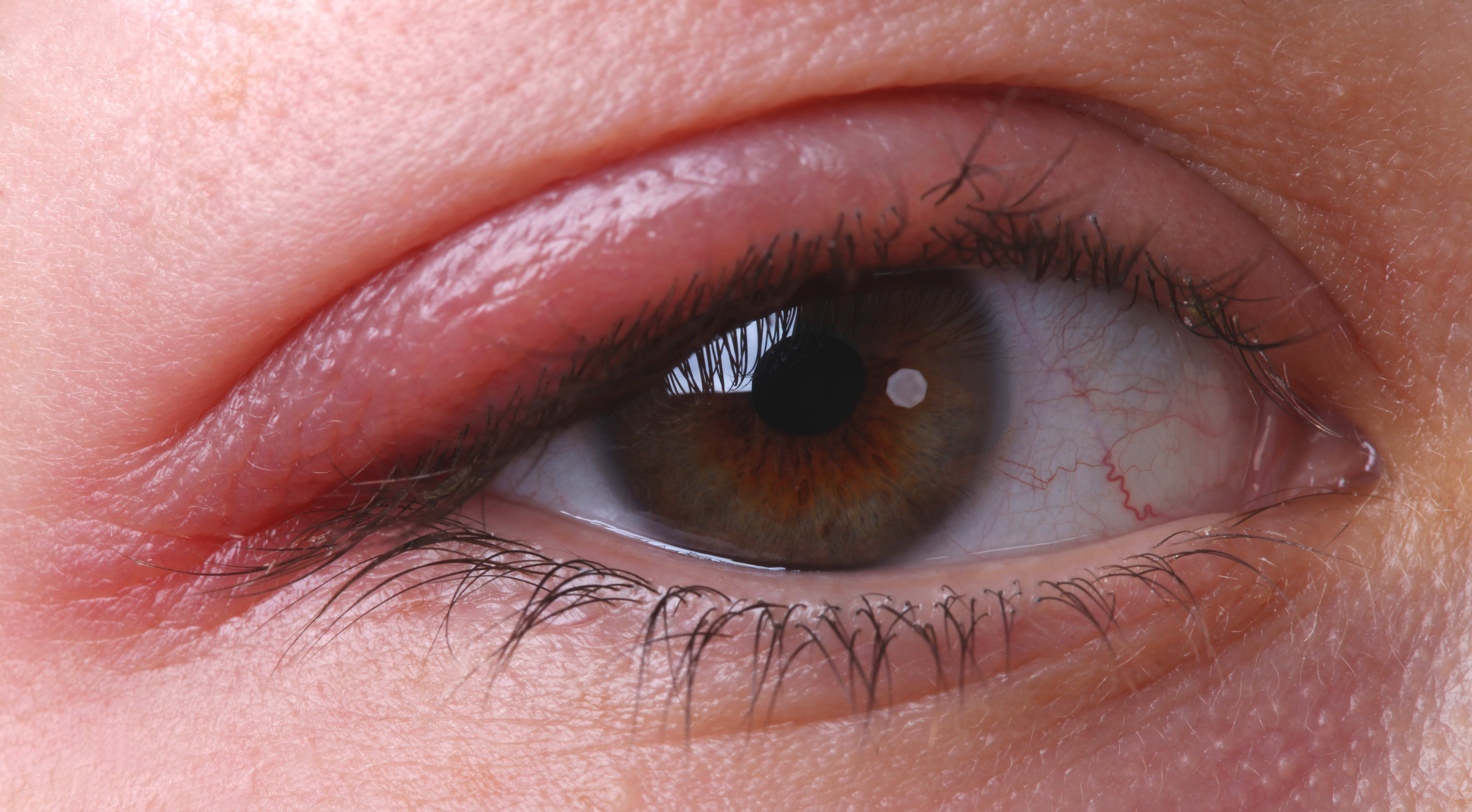blepharitis