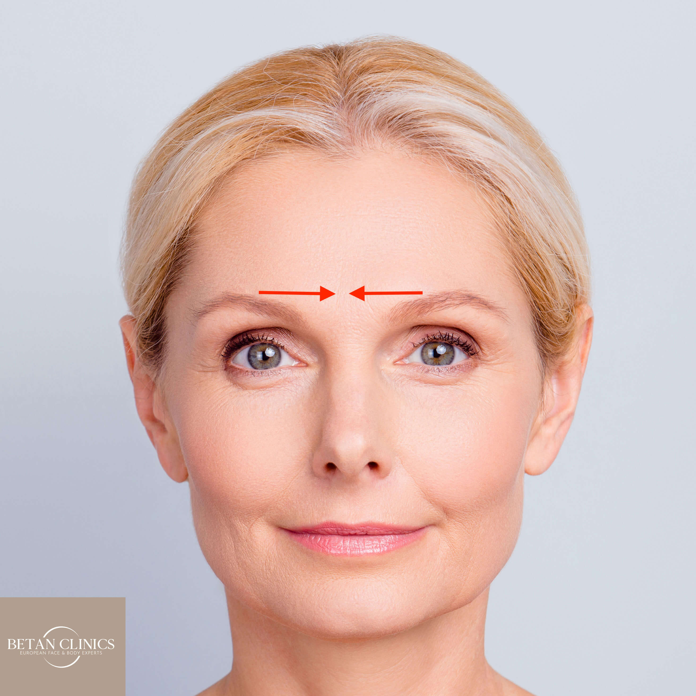 Horizontale fronsrimpel botox behandeling, fronsrimpel verminderen, frons rimpels verwijderen verminderen als rimpelbehandeling