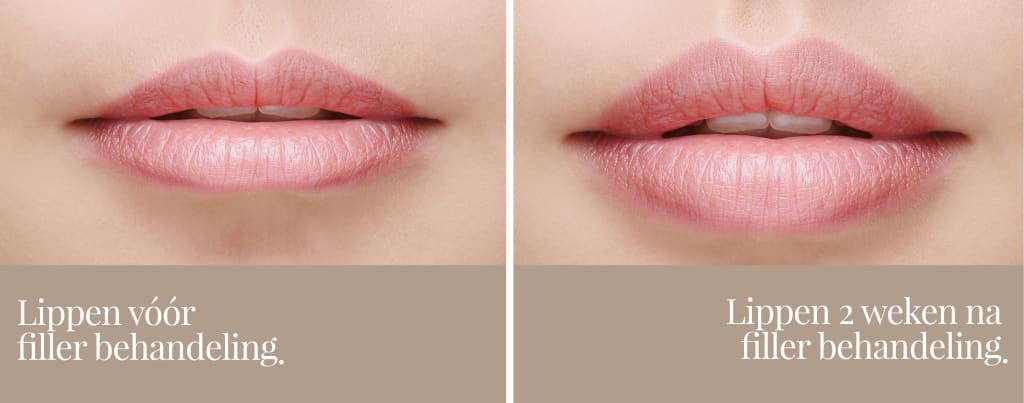 voor na lip fillers betan clinics
