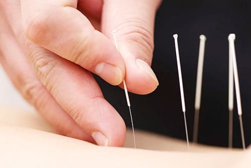 Acupuncture Needles