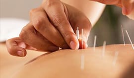 Acupuncture