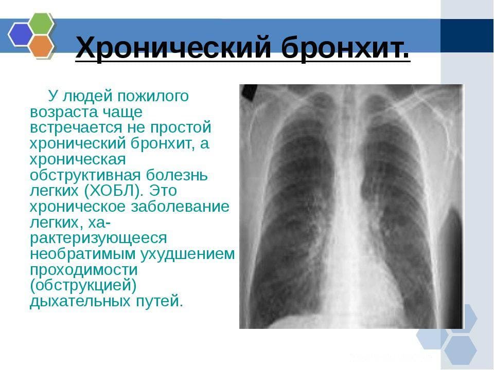 Явления бронхита. Хроническое воспаление бронхов. Ренгенпризнаки хронического бронхита.