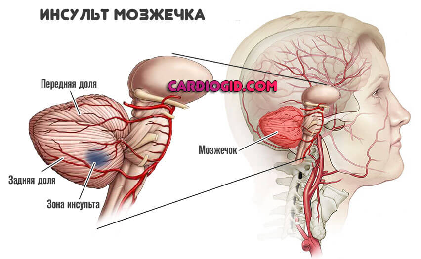 Мозжечок восстановление. Ишемический микроинсульт мозжечка. Инсульт мозжечка последствия.