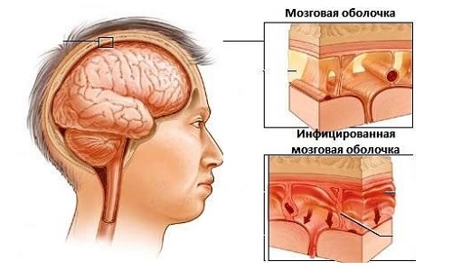 Гнойный менингит. Риногенныйгной Гнойный менингит. Гнойный менингит симптомы. Гнойный менингит головного мозга.