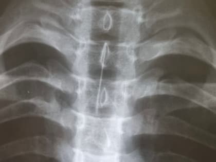 Хирурги Иркутской больницы извлекли из трахеи подростка иглу от шприца