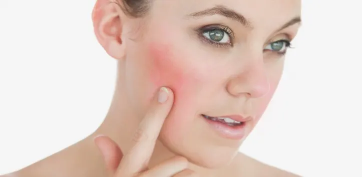 treat-rosacea