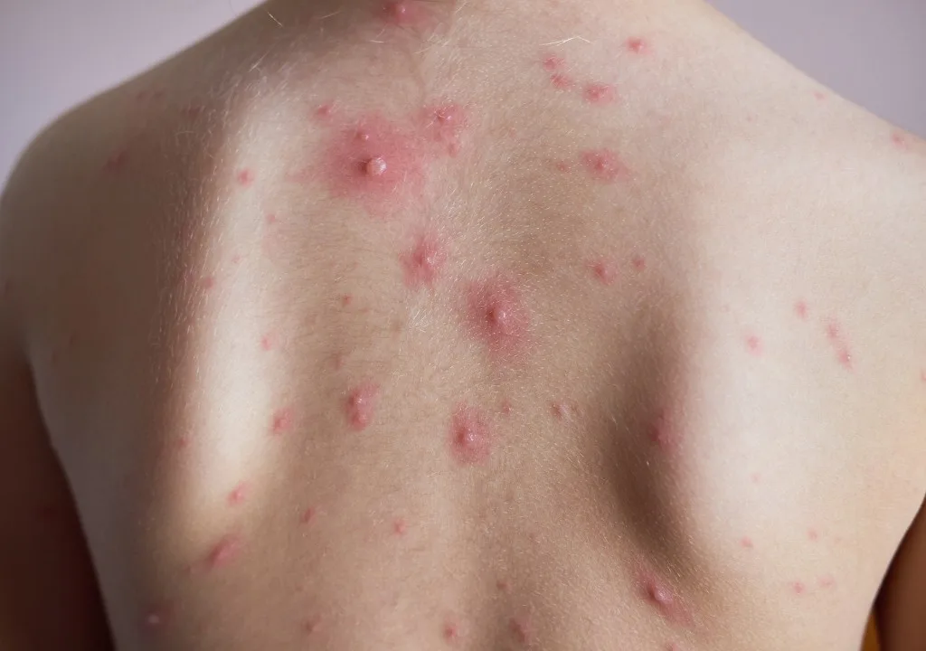 vi-sao-noi-man-ngua-vung-lung-lam-sao-dje-khac-phuc