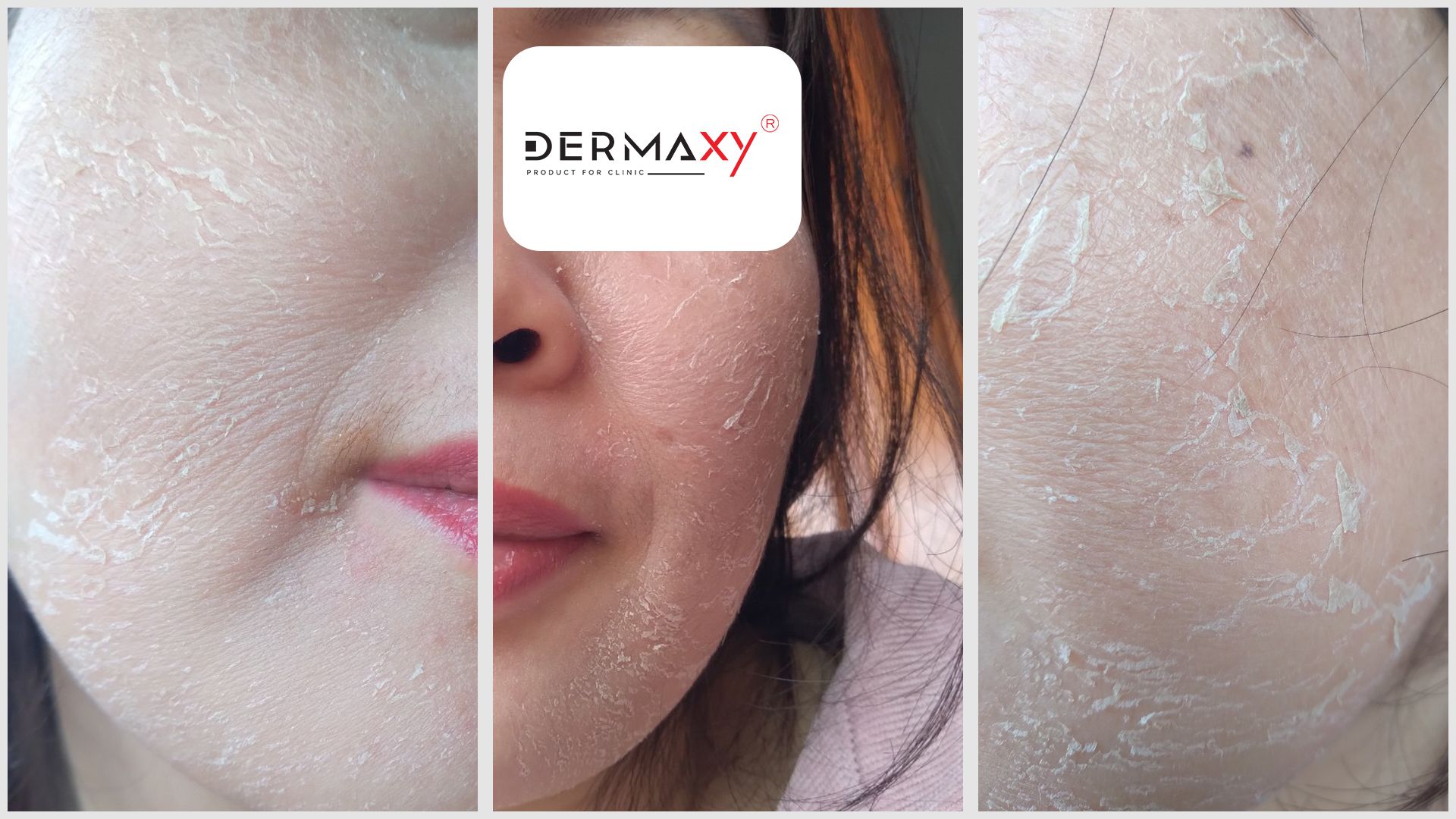 Da bong nhiều, kích ứng mạnh