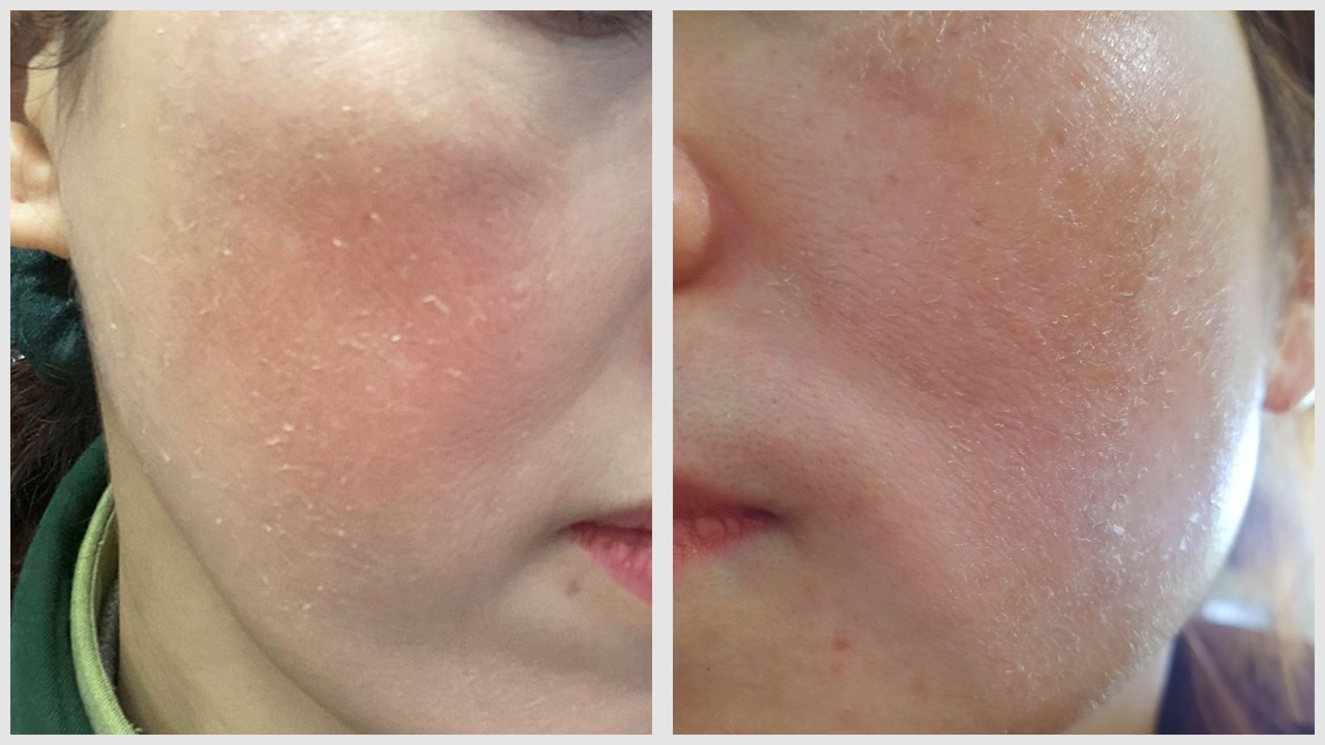 Bong mùn nhẹ, hồng ban