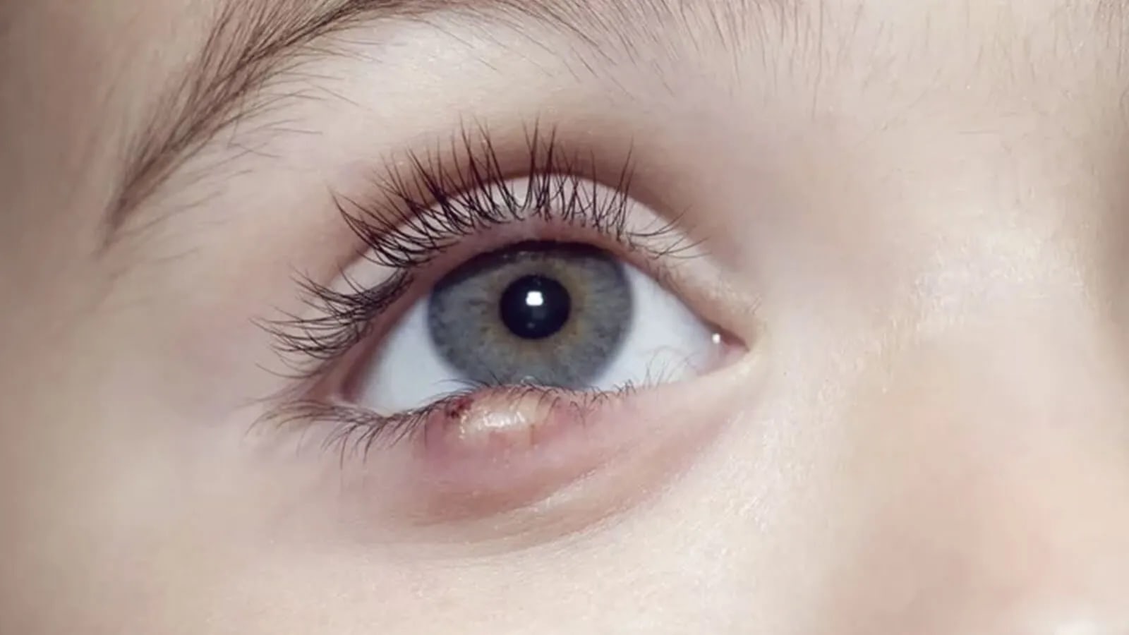What is Stye and how to get rid of it?