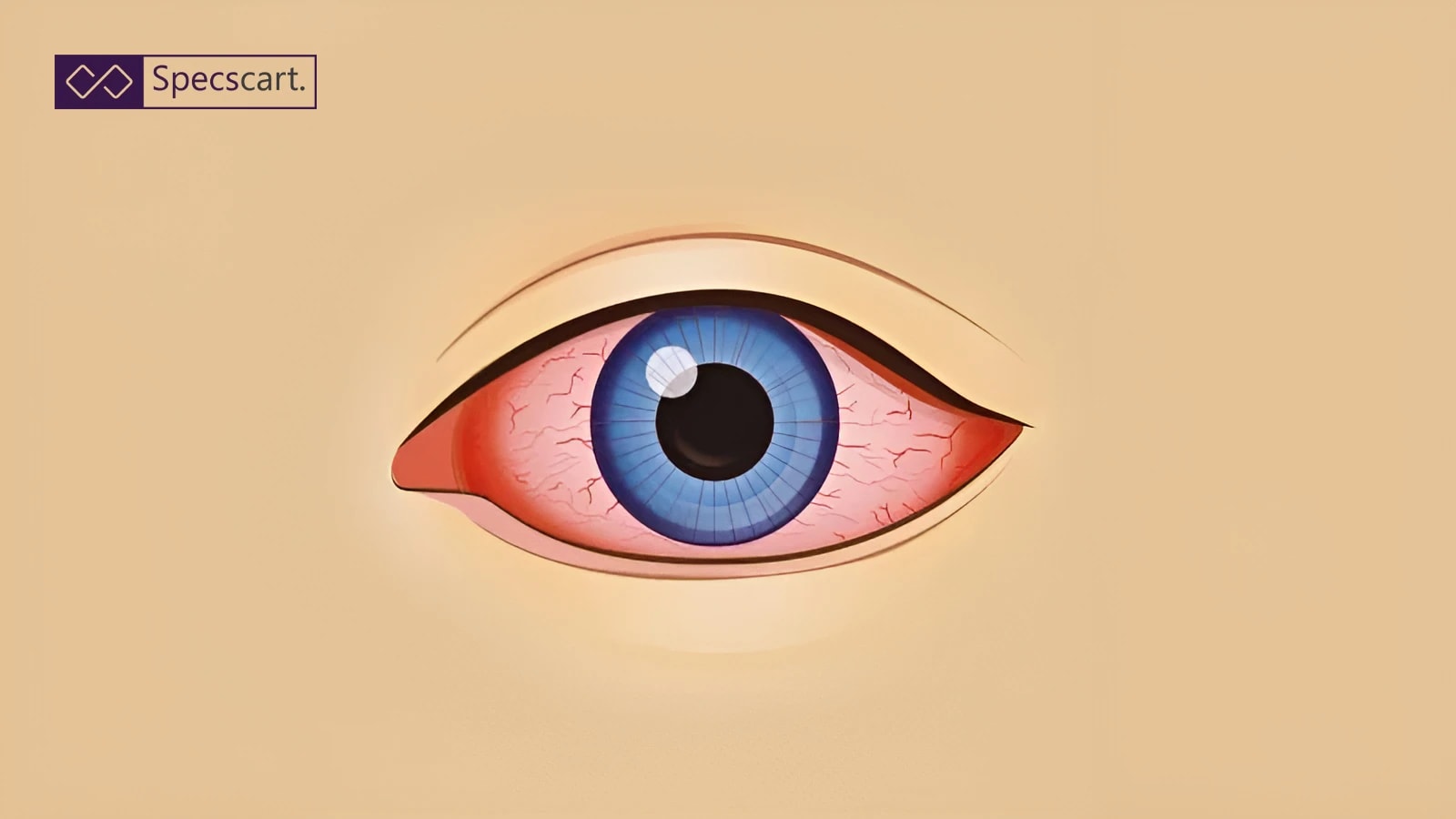 What You Should Know About Bloodshot Eyes (Red Eyes)?
