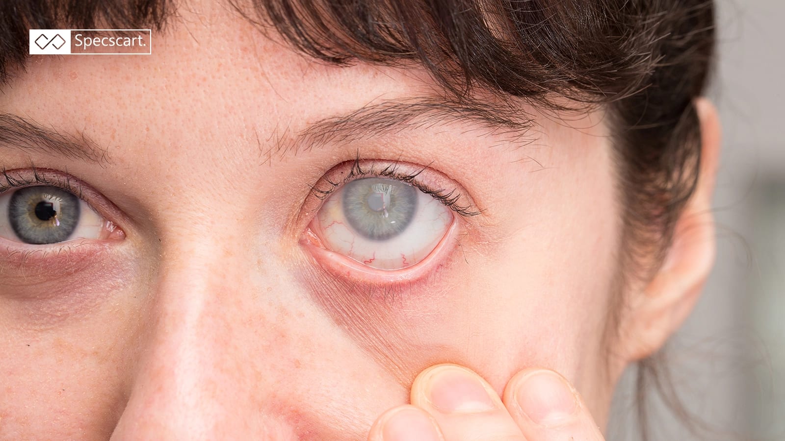 Top 10 Questions About Cataracts