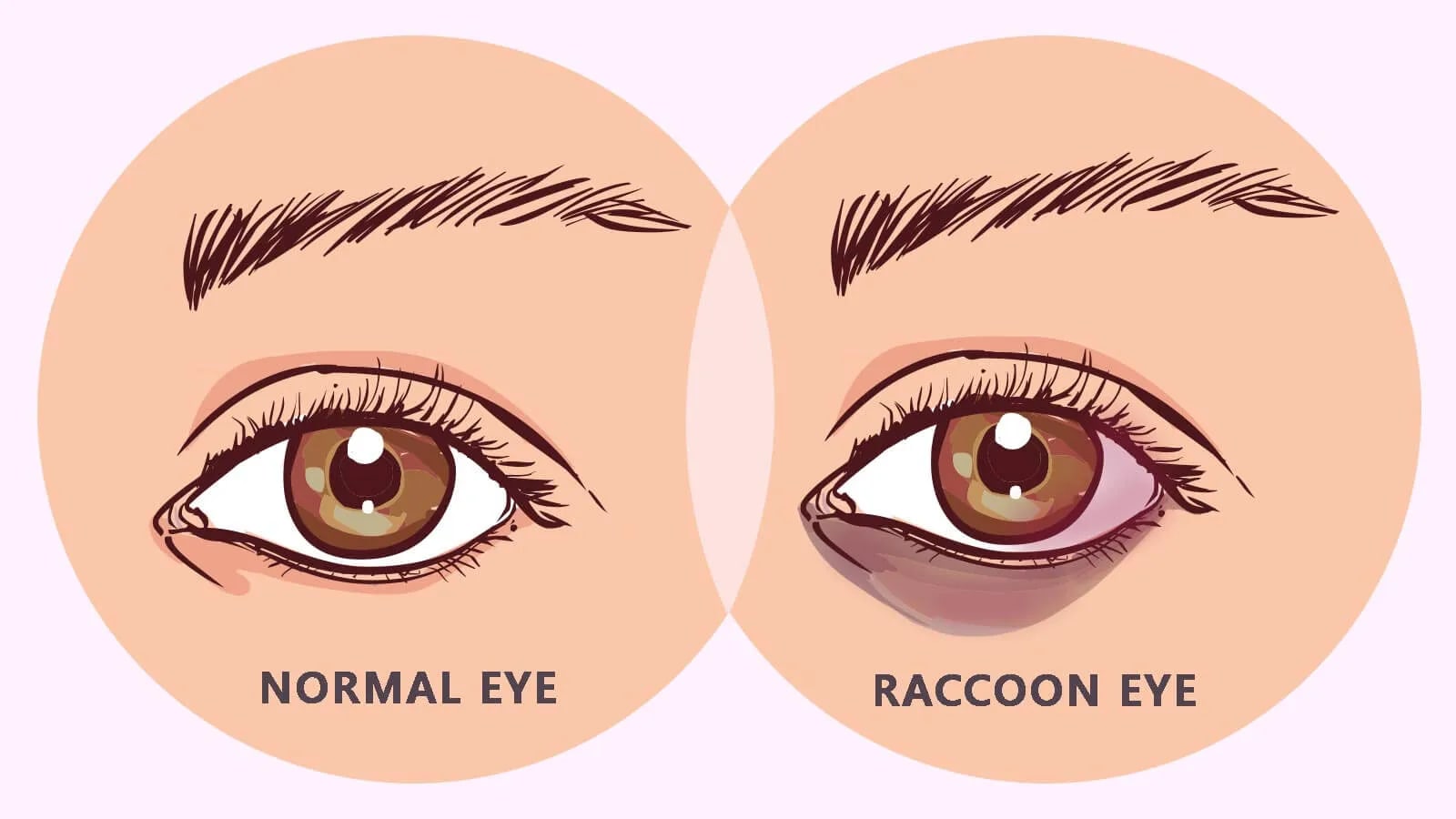 Medical illustration comparing a normal eye to a raccoon eye, showing dark, bruise-like discoloration under the lower eyelid.