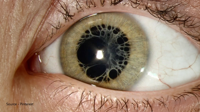 Treatment for polycoria
