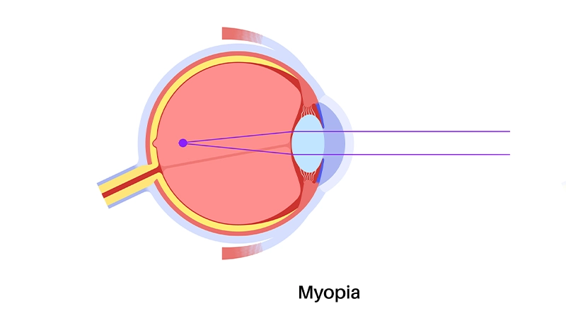 What Does Nearsightedness Mean