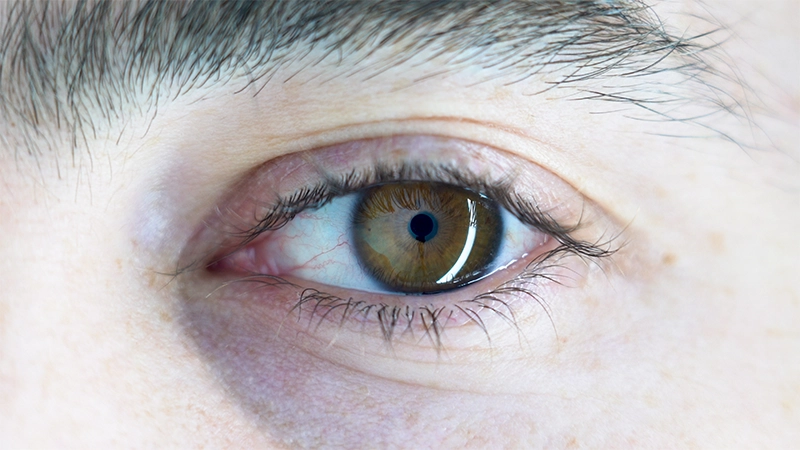 Common Sports-related Eye Injuries