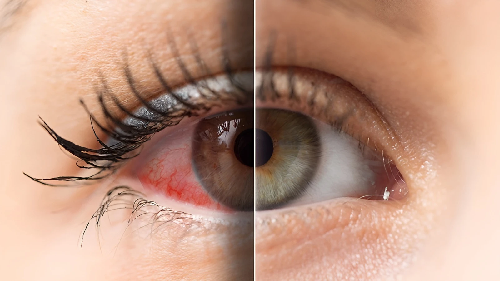 Difference Between Eye Damage and Eye Strain