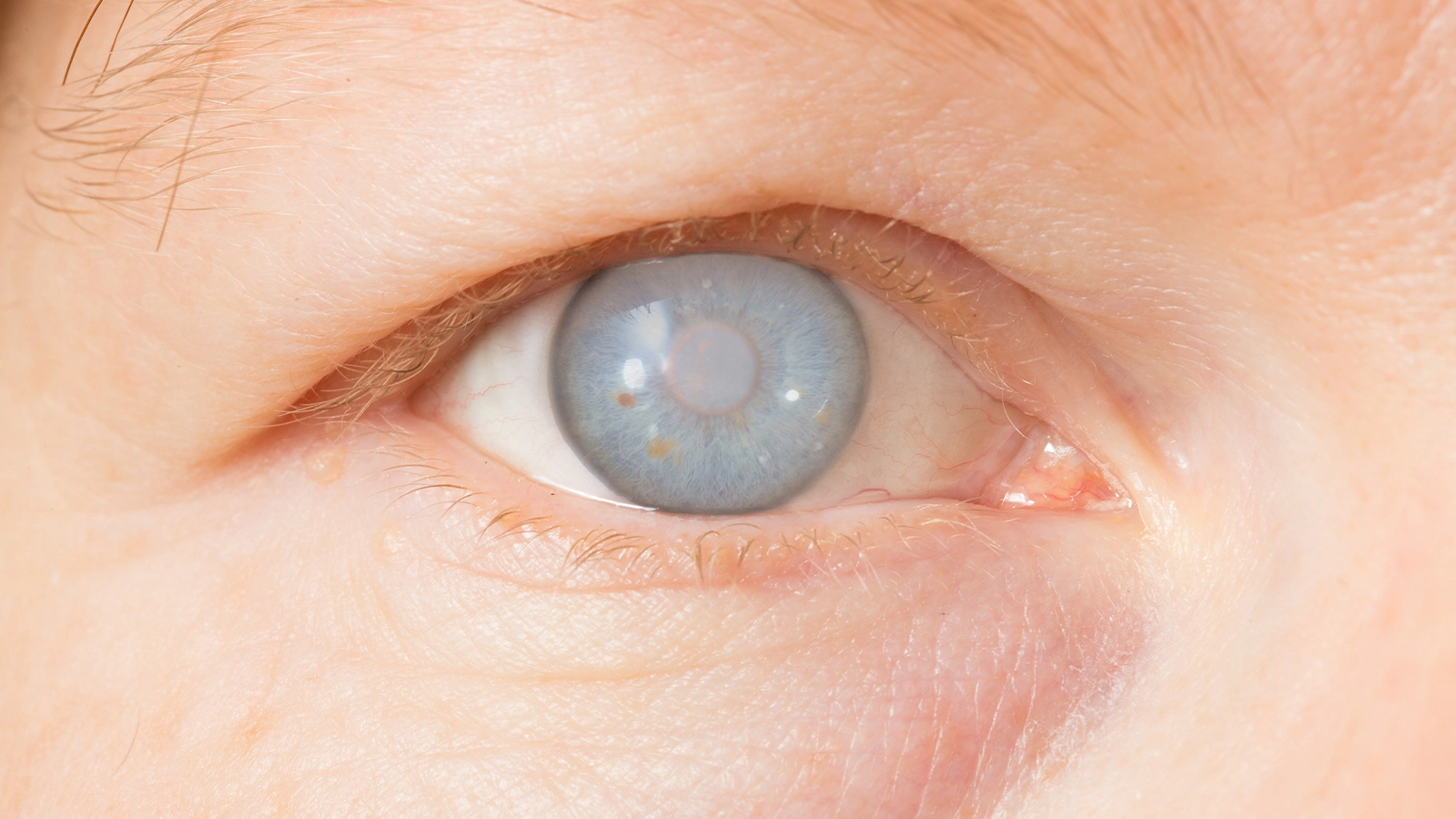 Corneal Ulcer