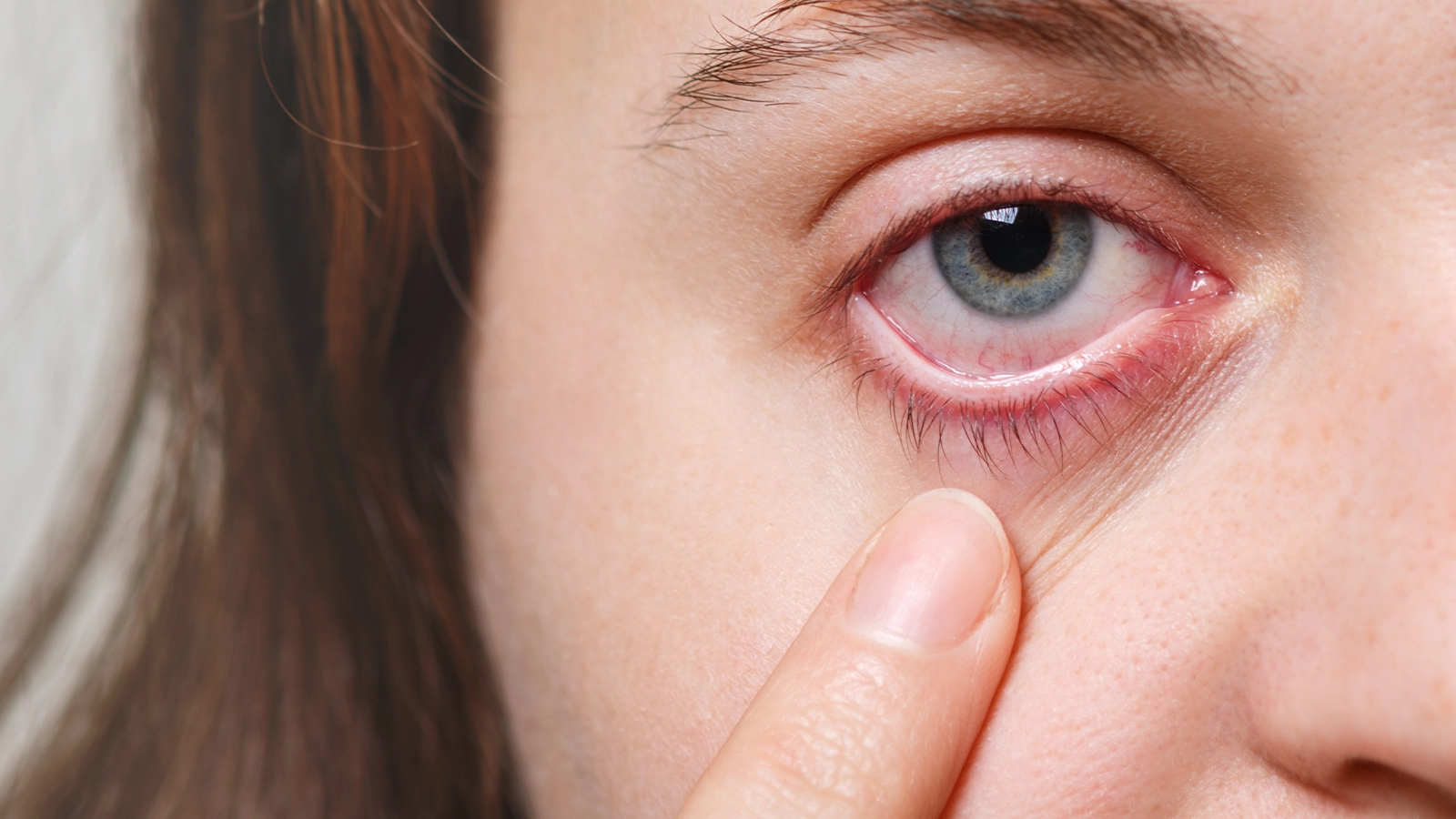 Corneal Abrasion