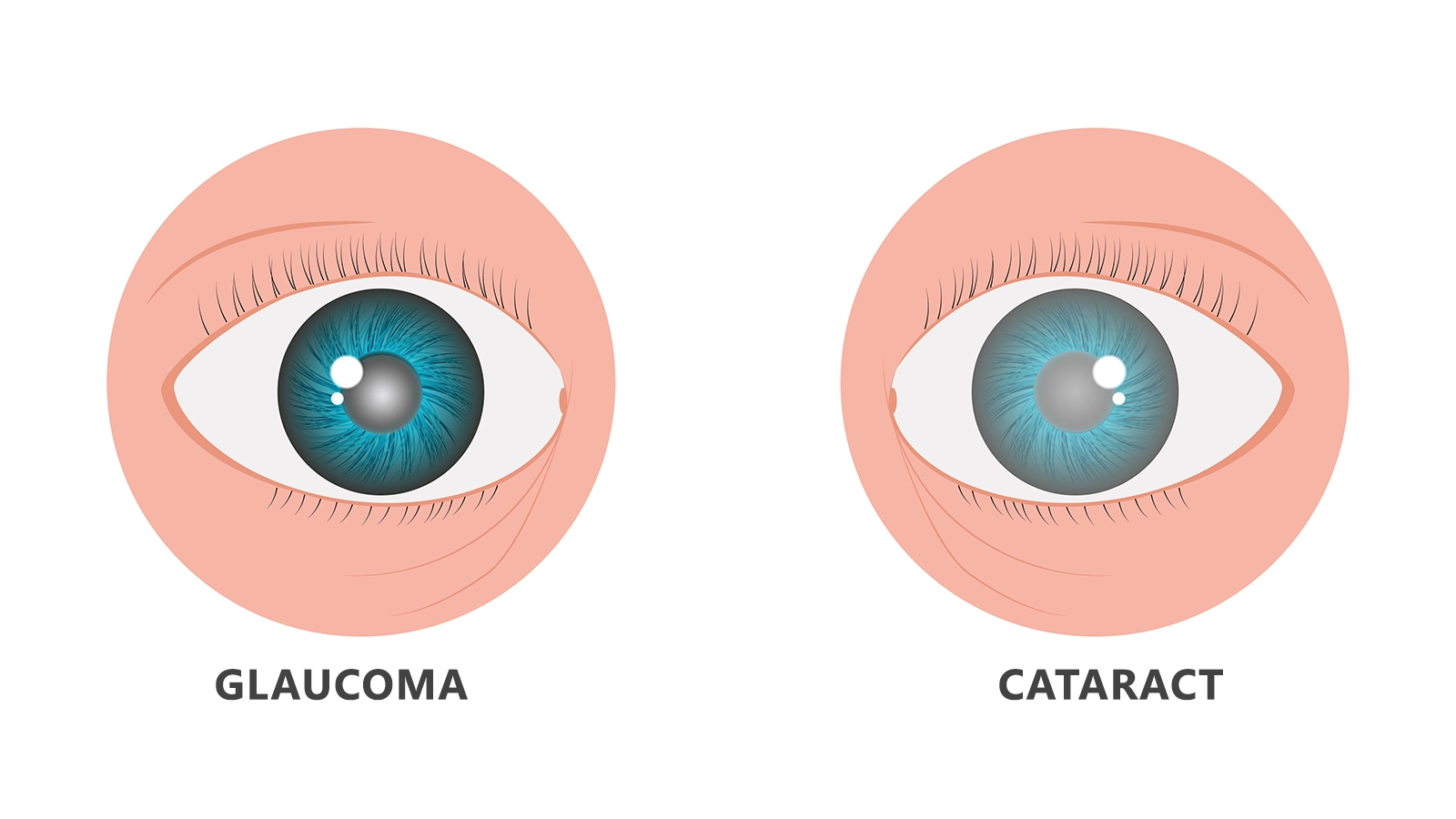 Excessive Exposure to Sun Can Cause Cataracts & Glaucoma