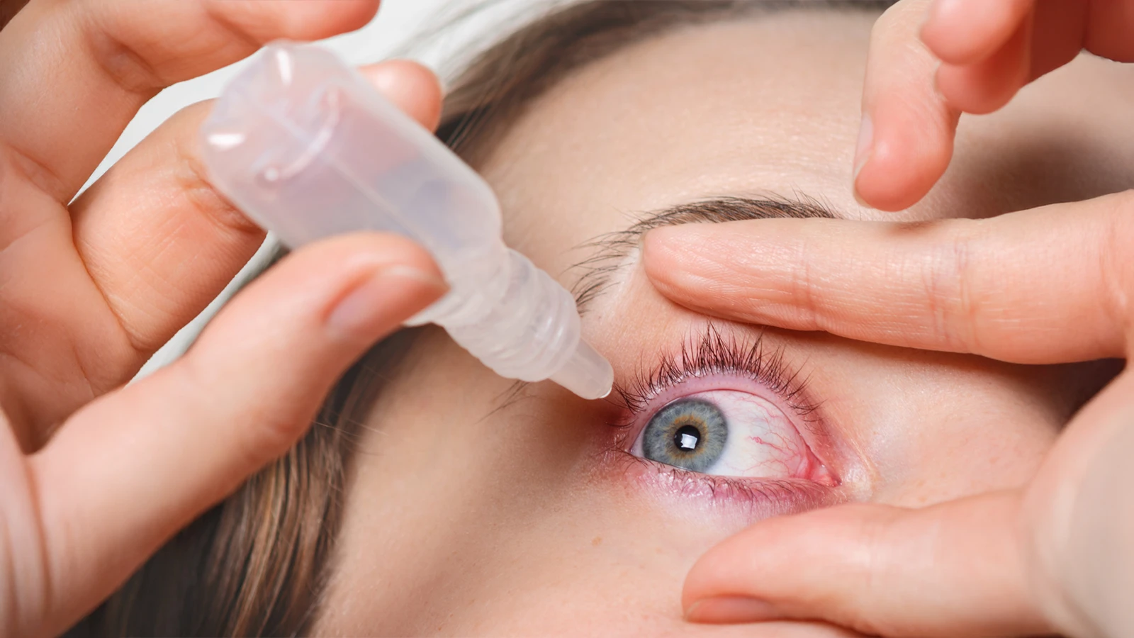 How Can You Treat Hyphema