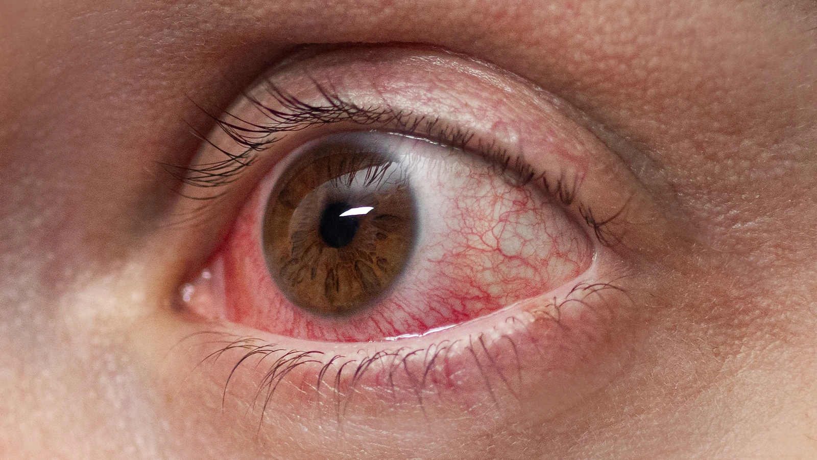 Symptoms of Bloodshot or Red Eye
