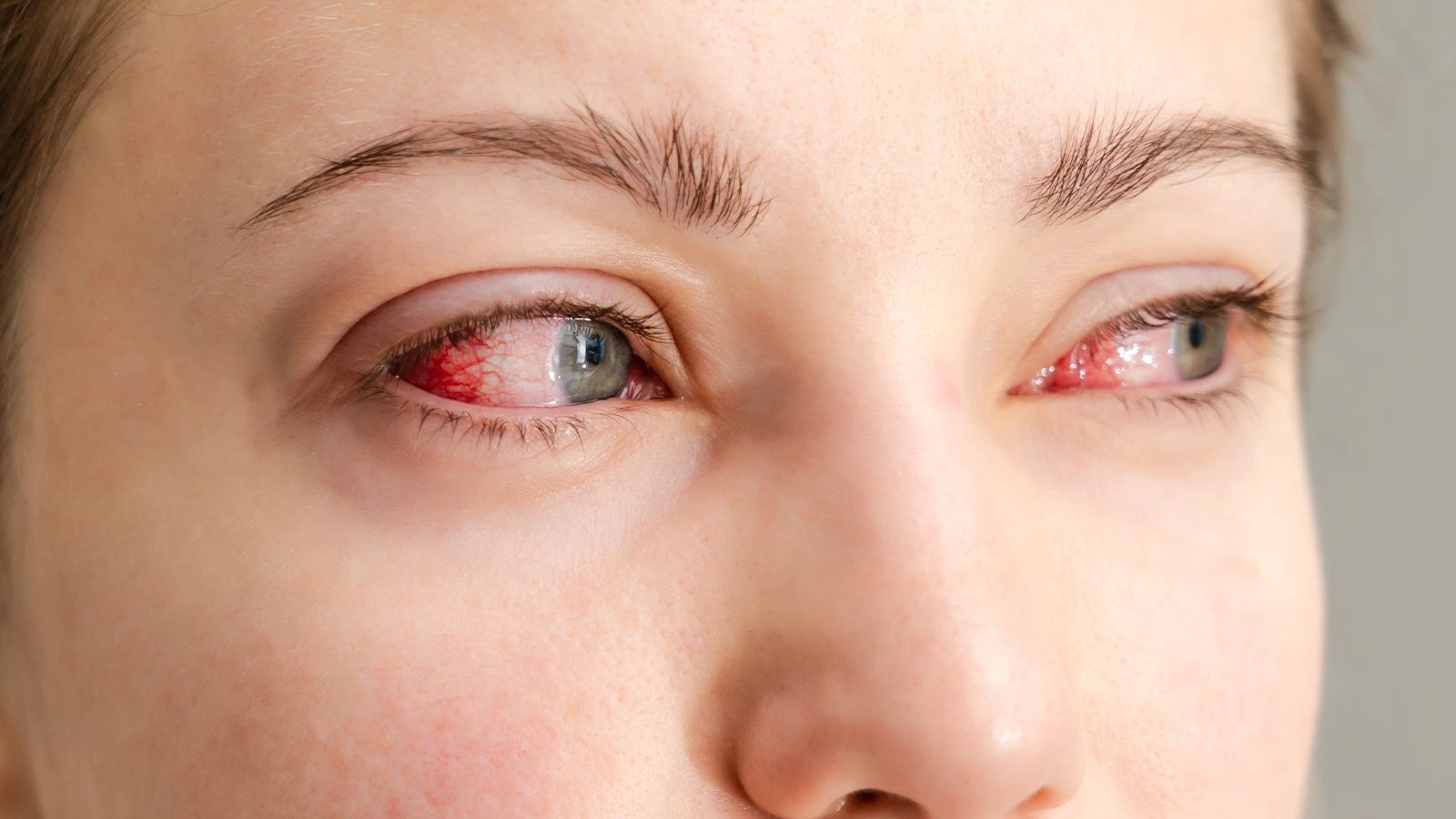 Causes of Bloodshot Eyes