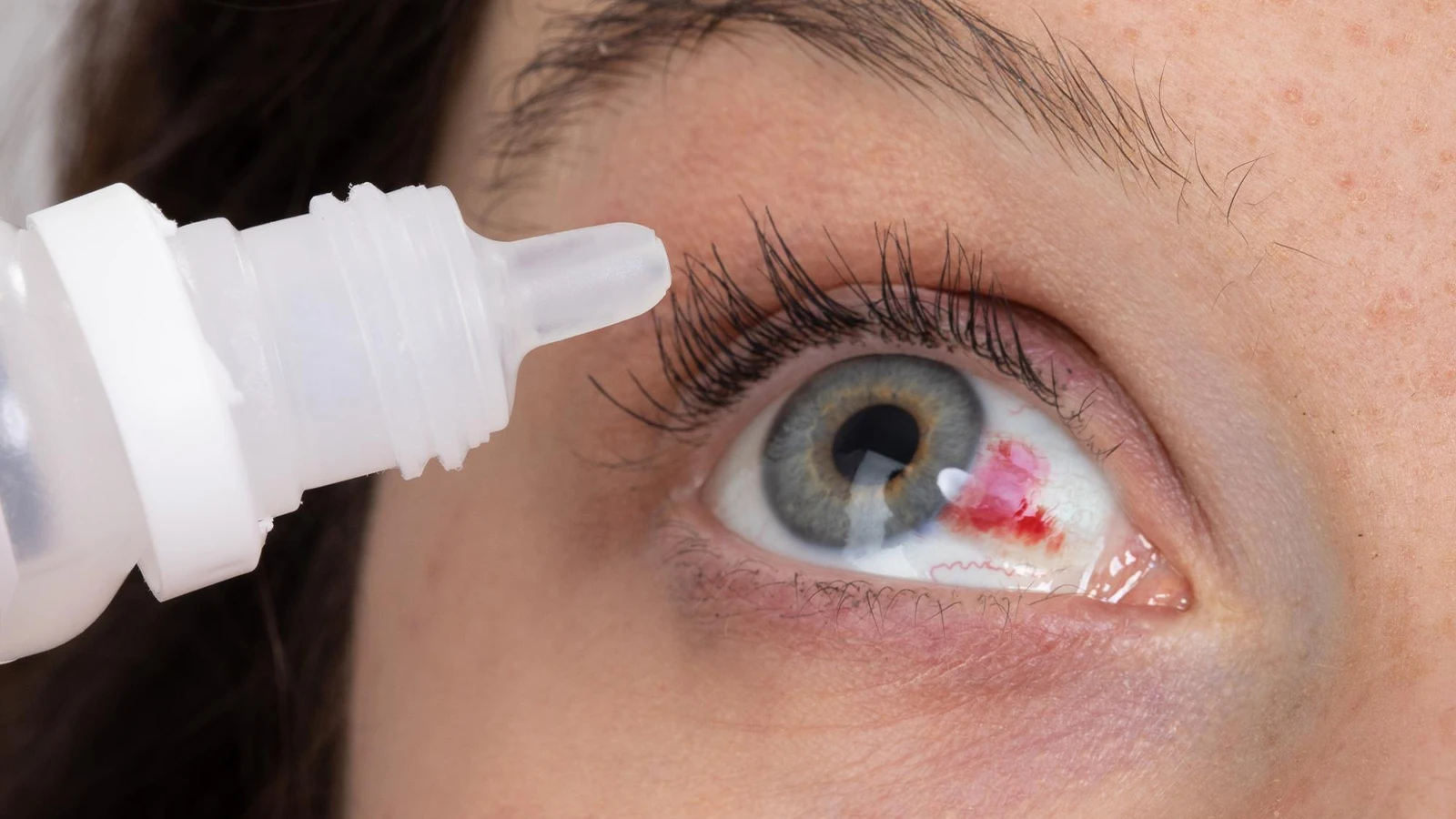 Methods for Red Eye Treatment