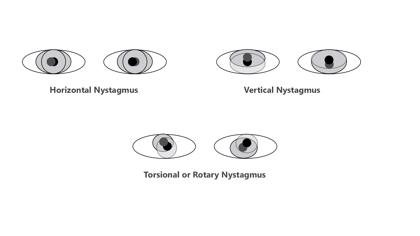 What are the Types of Nystagmus