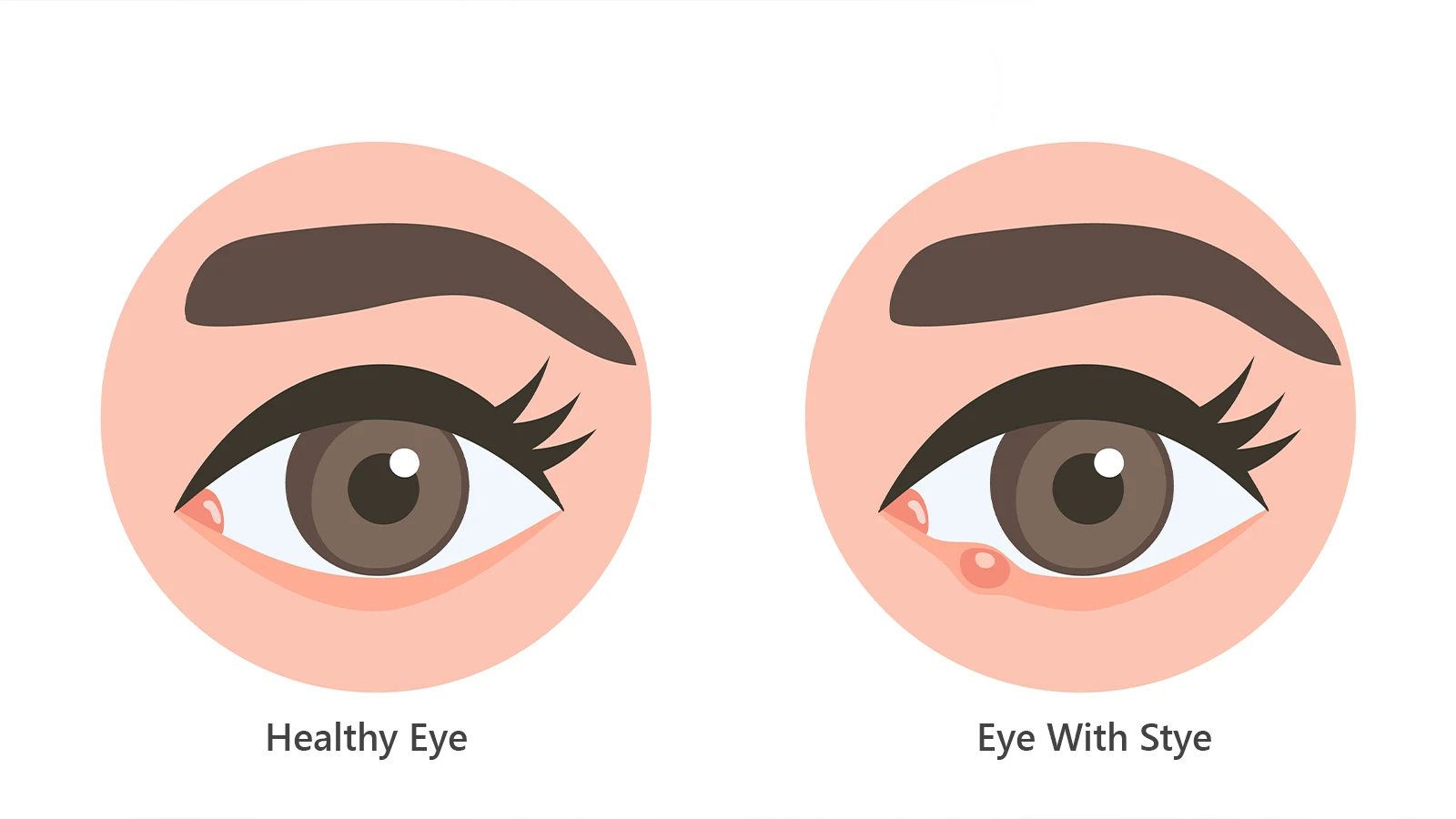 What are the Causes of a Stye