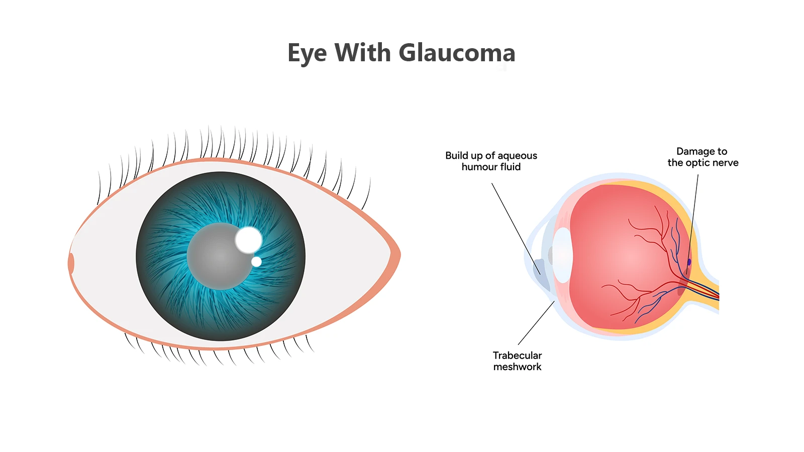 What are the Causes of Glaucoma