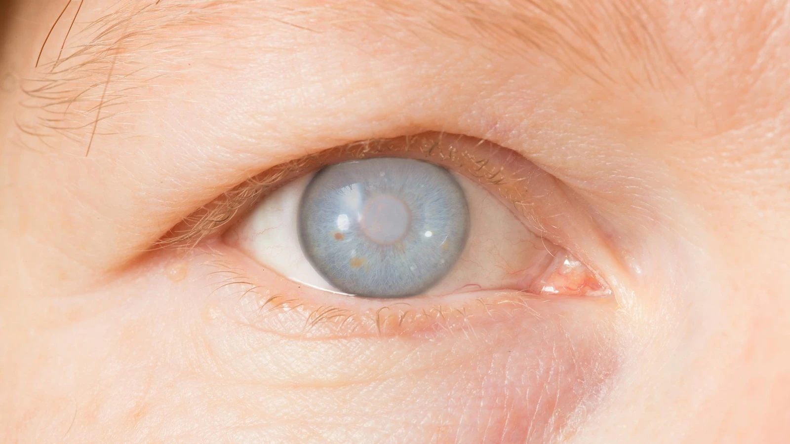 What are the Risk Factors of Glaucoma