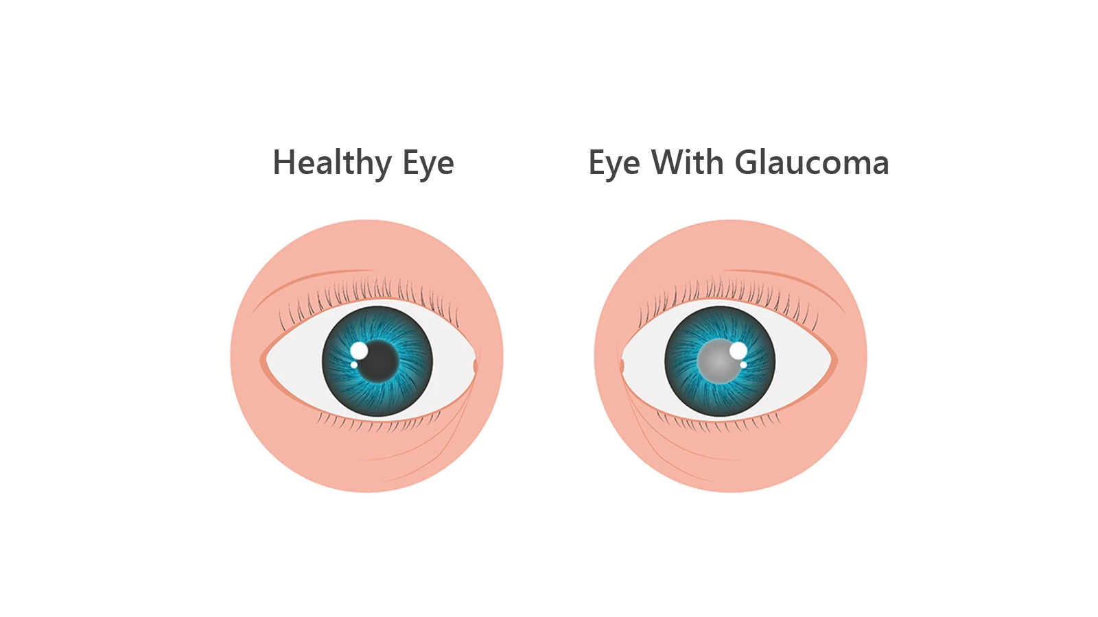 What are the Symptoms of Glaucoma