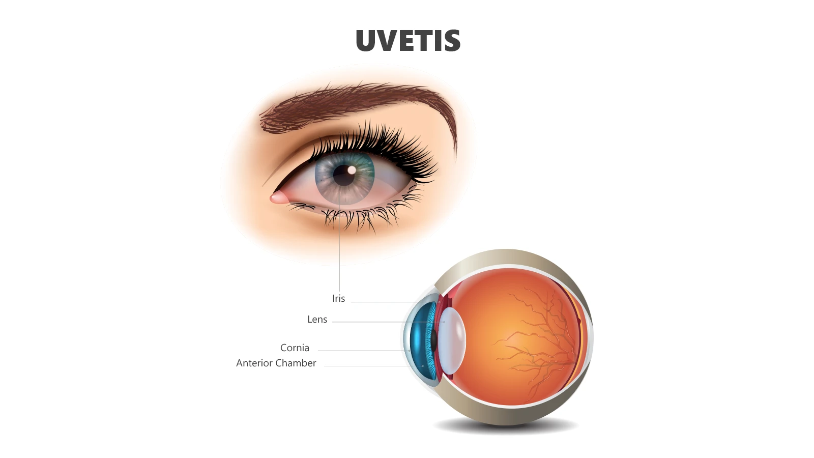 What is Uveitis