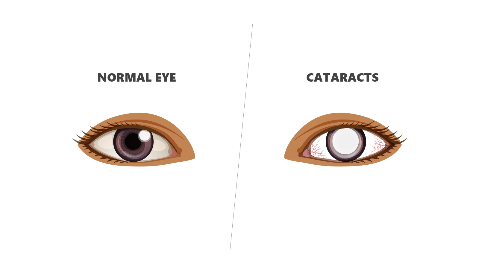 Complications of Uveitis