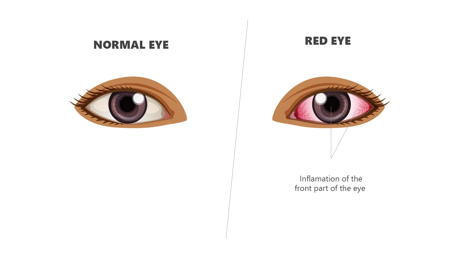 Symptoms of Uveitis