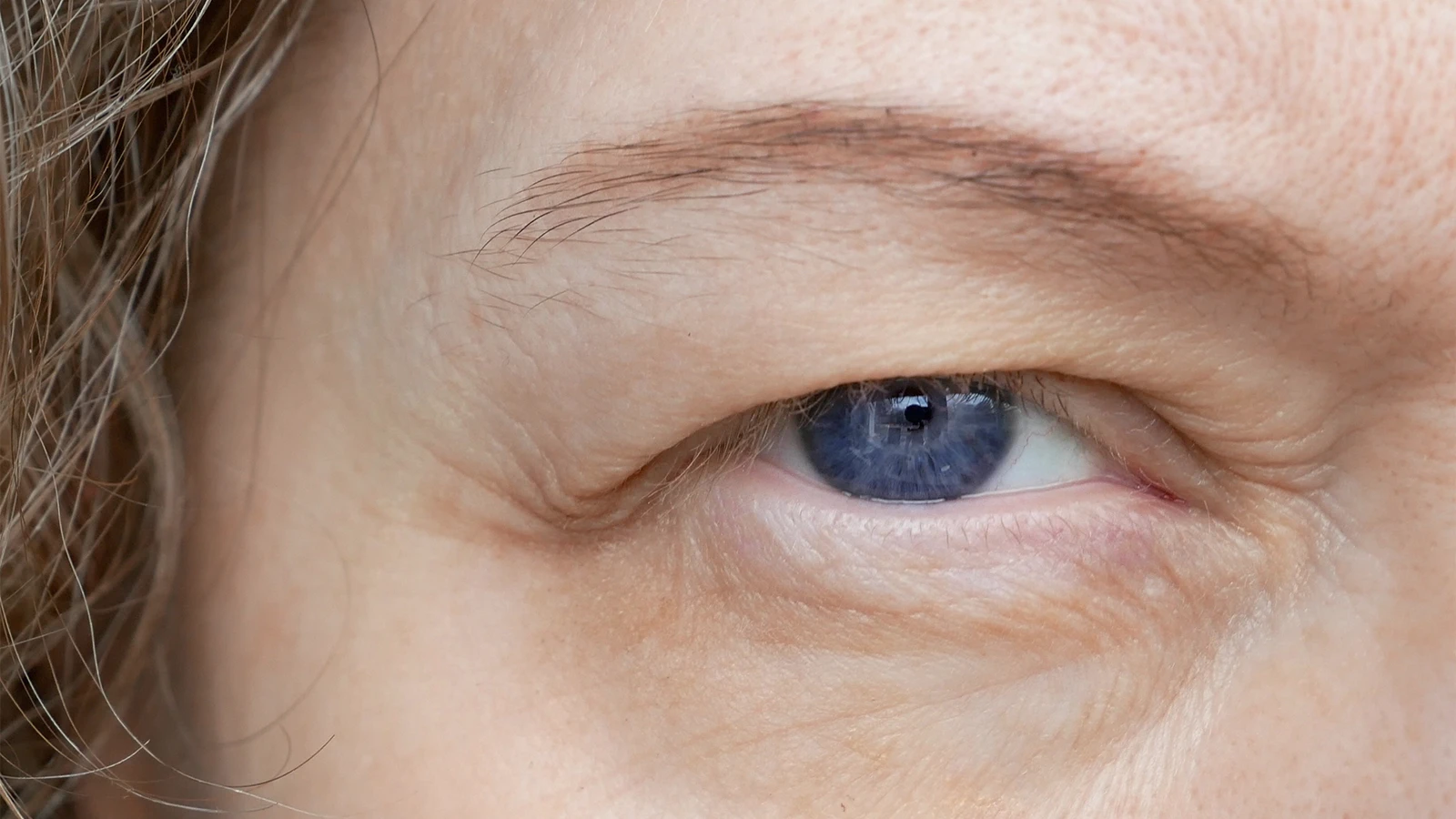 Treatment of Ptosis