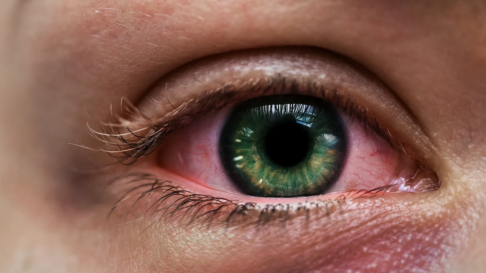 Conjunctivitis (Pink eye)