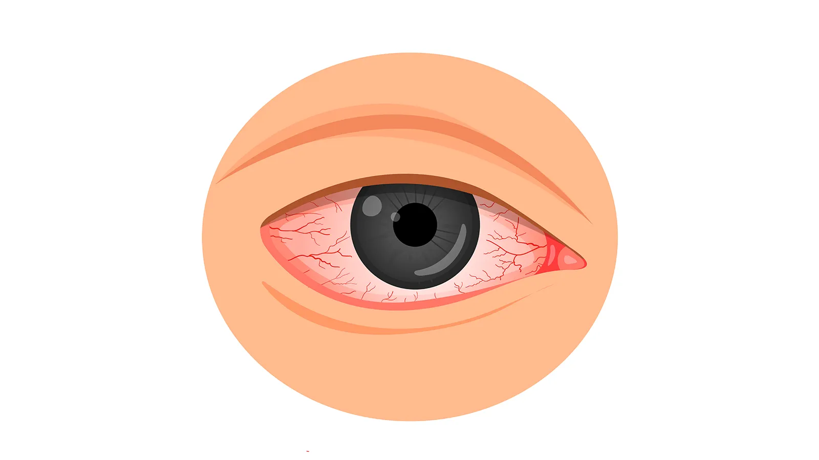 Keratitis