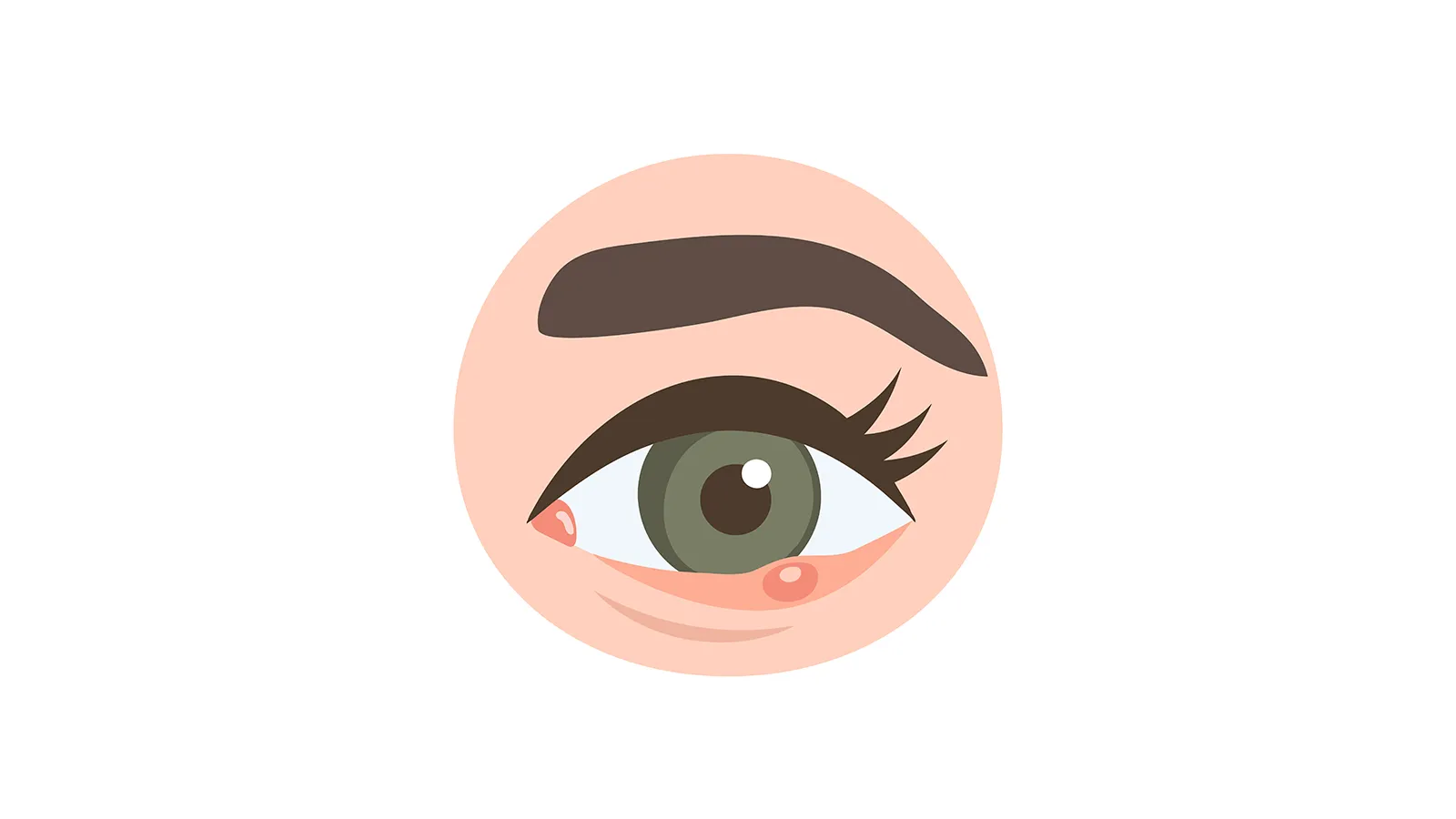 Stye