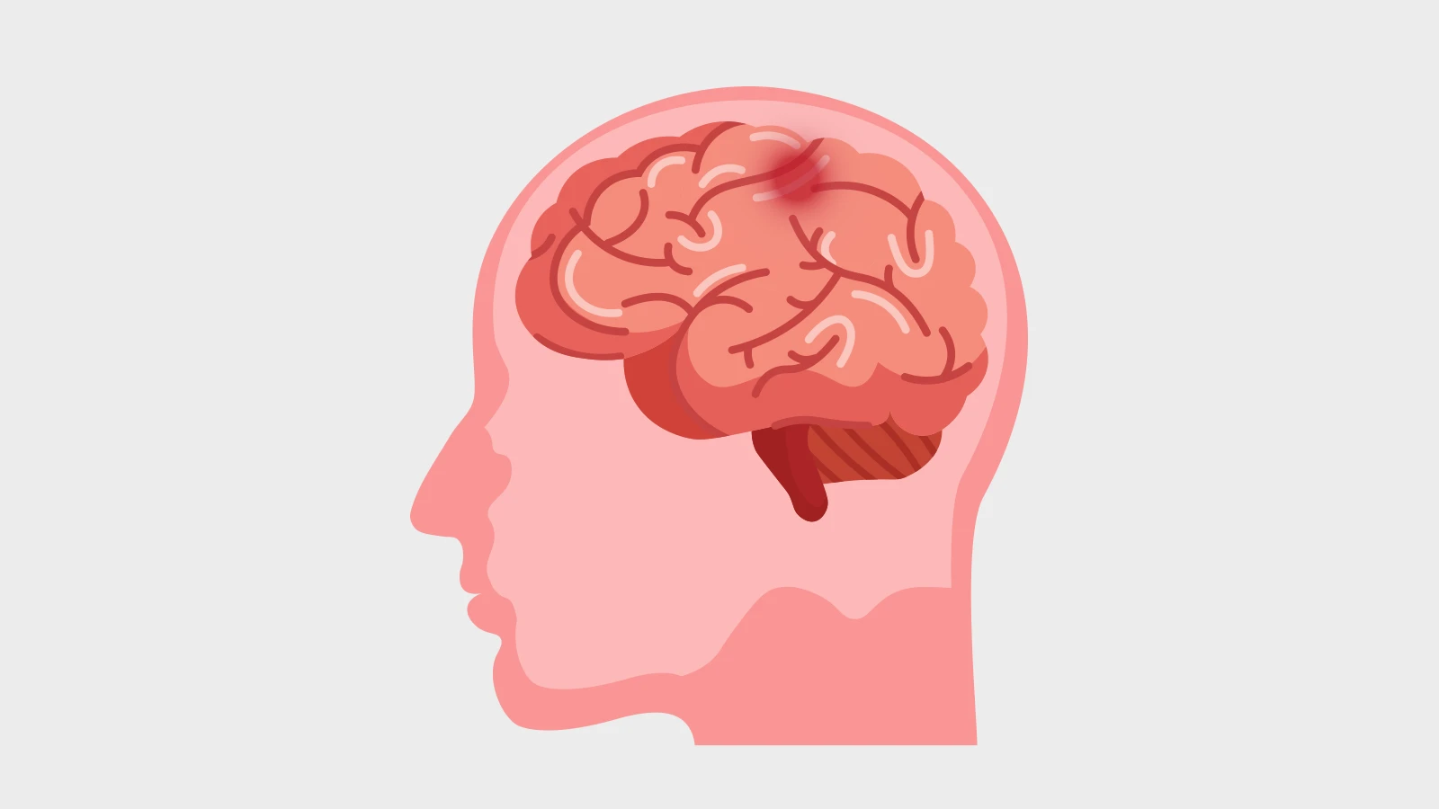 Stroke